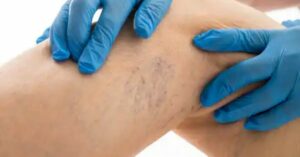 8 regole da seguire se vuoi curare le vene varicose