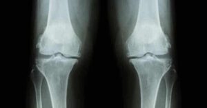 Sintomi della cartilagine consumata