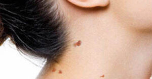 Cervicobrachialgia: cos’è quel dolore che va dal collo al braccio?