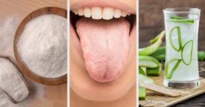 Puoi sbarazzarti della lingua bianca con questi 8 rimedi naturali
