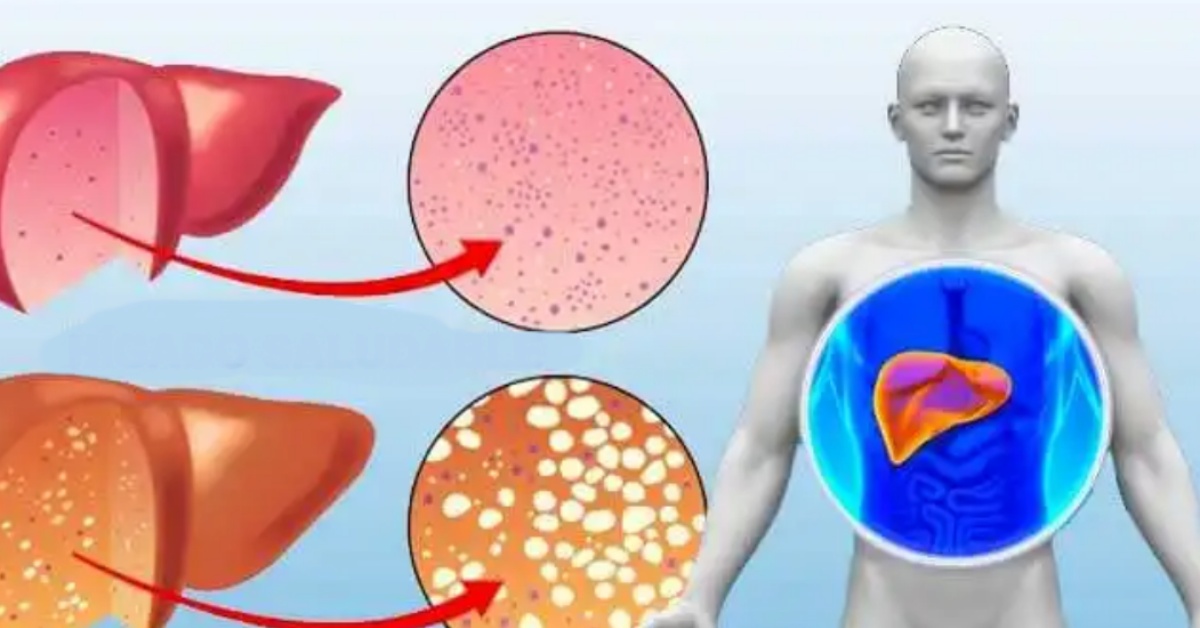 fegato pulito e fegato grasso