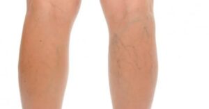 5 soluzioni di origine naturale per trattare la flebite