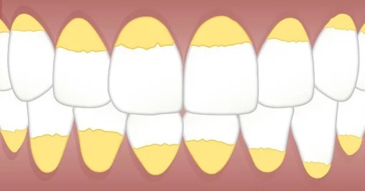 Rimedi contro il tartaro