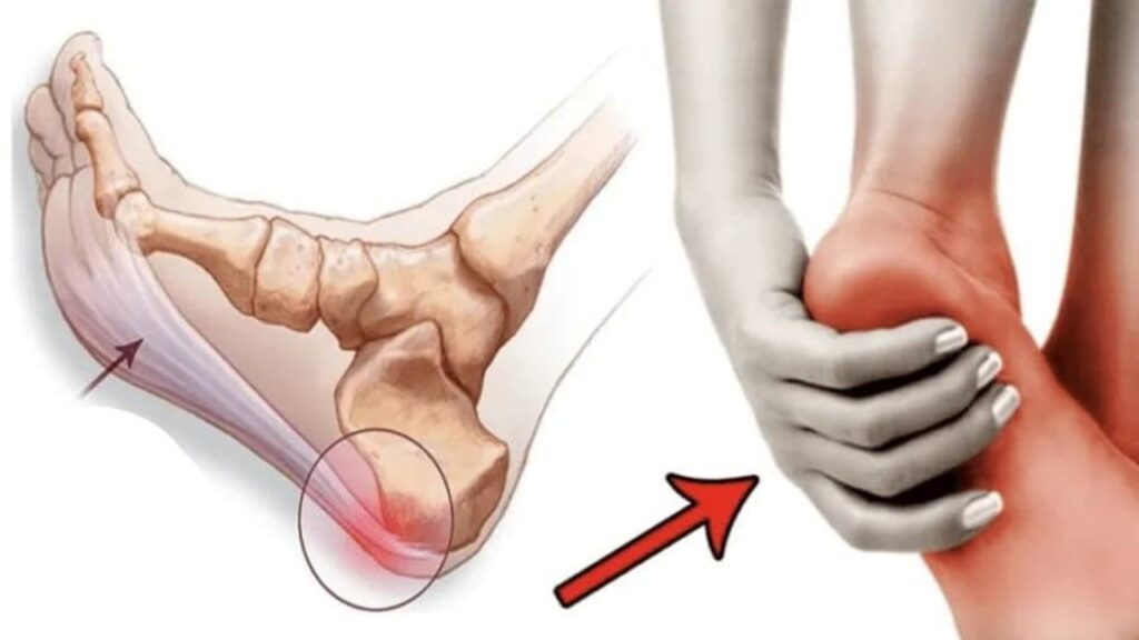 sintomi e trattamenti Fascite plantare