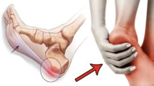 I migliori rimedi per controllare la fascite plantare