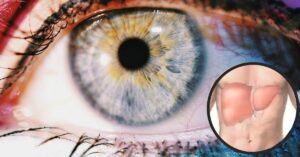 Come sapere se il nostro fegato è infiammato?