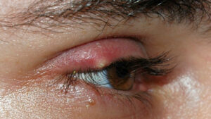 Consigli per curare e prevenire l’orzaiolo