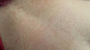 Che cos’è la tinea versicolor, i rimedi più comuni