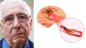 Perché la tempestività è determinante in caso di ictus