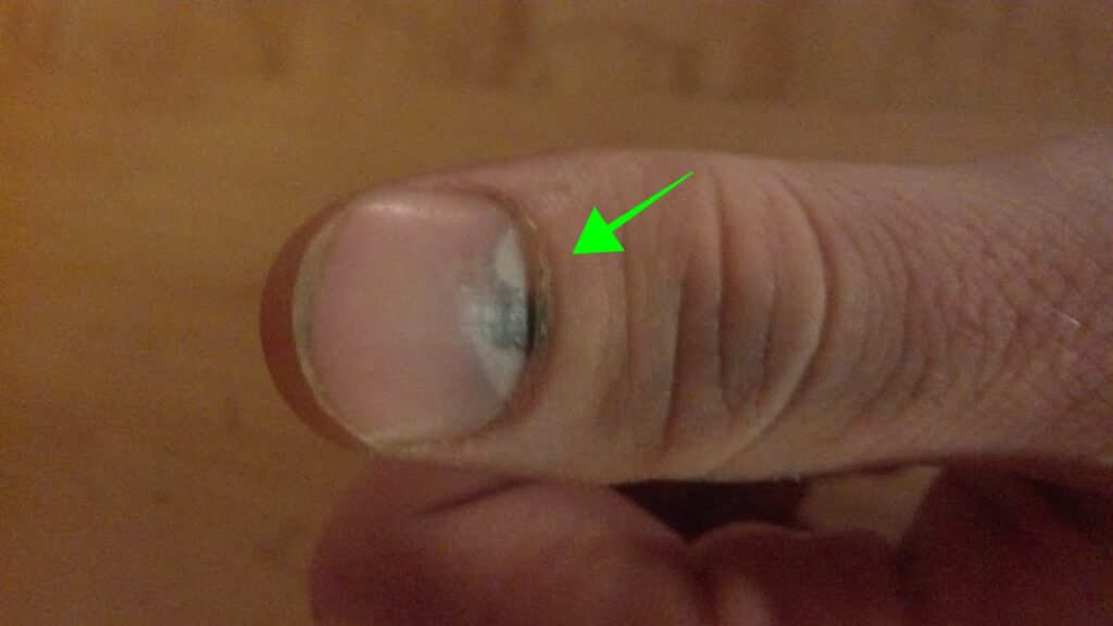 unghia con ematoma subungueale