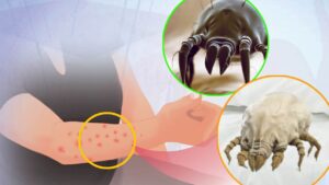 Punture di acari: sintomi, cure e prevenzione