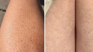 Le chiamano gambe di fragola. Perché succede e come risolvere il problema