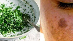 Macchie, acne e rughe sulla pelle? Usa così il prezzemolo