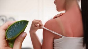 Quando ti ustioni al mare o in piscina curati con l’aloe vera: ecco come devi utilizzarla