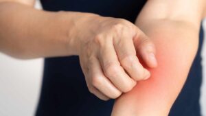 Prurito e irritazioni dopo un’escursione all’aria aperta? La colpevole potrebbe essere la cimice pruriginosa, ecco cosa dovresti sapere