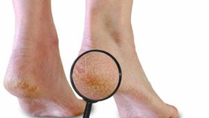 Talloni screpolati: tutti i rimedi naturali che funzionano davvero