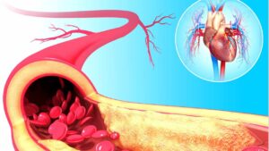 Scopri 5 alimenti per purificare e rafforzare le tue arterie