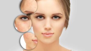 Acne e cicatrici: prova questi rimedi naturali