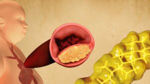 Come riconoscere i segnali del colesterolo alto? 10 sintomi da non sottovalutare mai