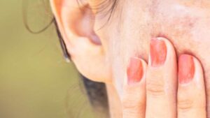 Come evitare le macchie dopo l’abbronzatura