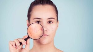 Acne estiva: cos’è e come intervenire