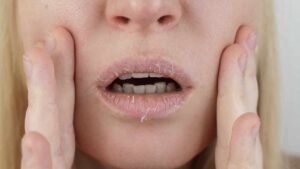 Hai le labbra secche e screpolate? Prova questi rimedi naturali per un sollievo immediato