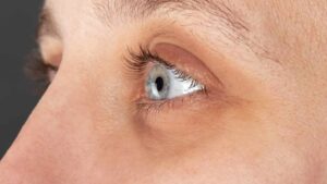 Hai mai sentito parlare della distrofia di Fuchs? Di cosa si tratta e perché accade