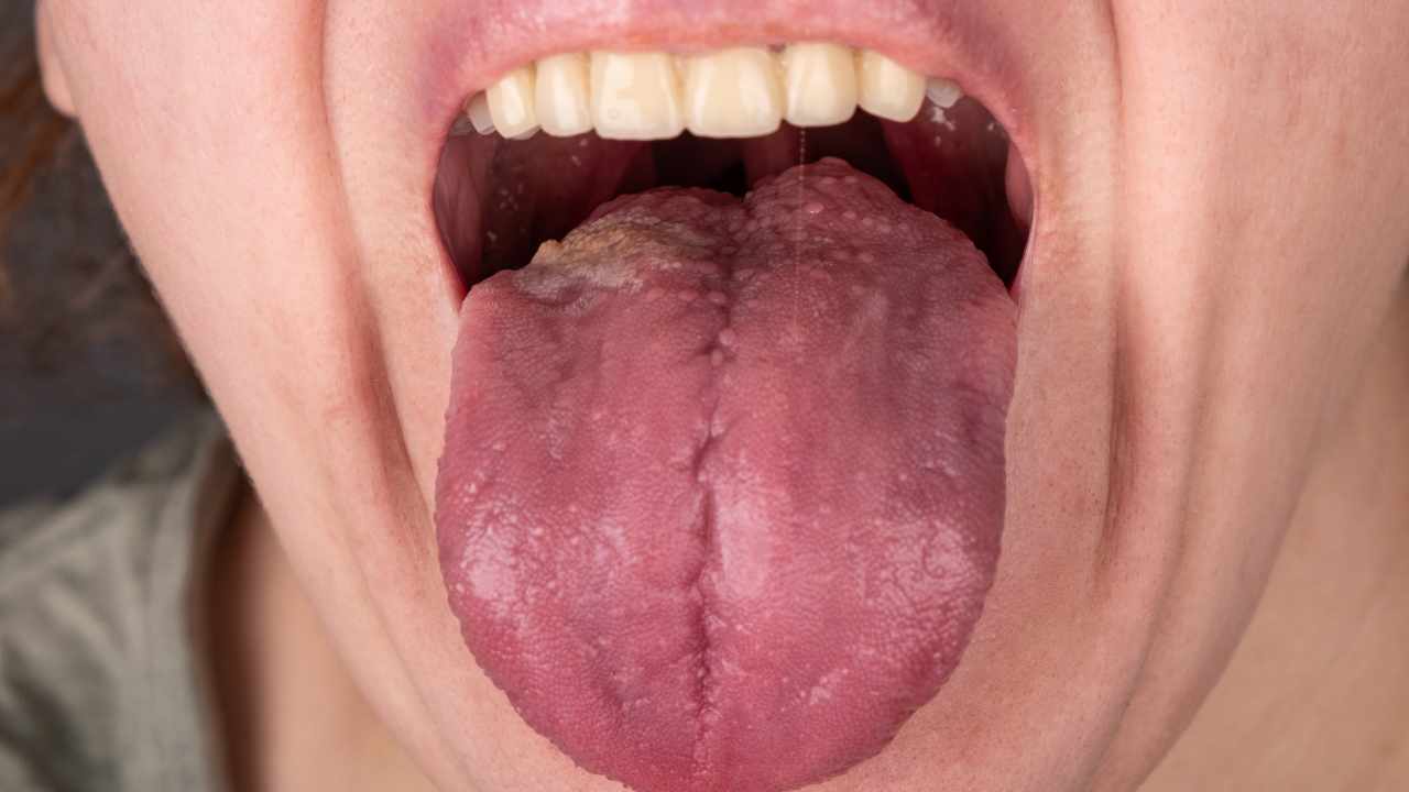 sintomi tumore alla lingua