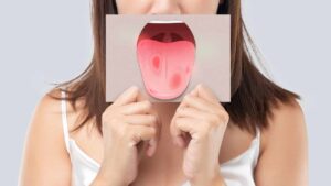 5 sintomi da non sottovalutare del tumore alla lingua: come riconoscerli tempestivamente