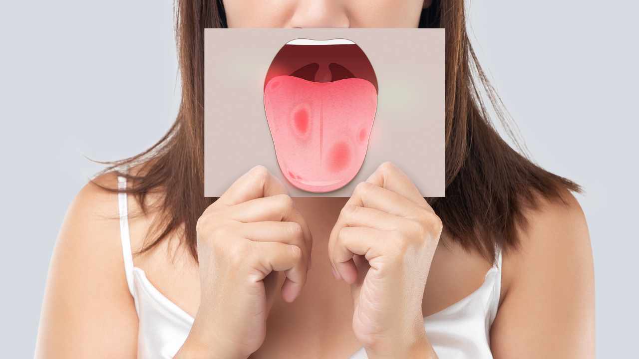 sintomi tumore alla lingua