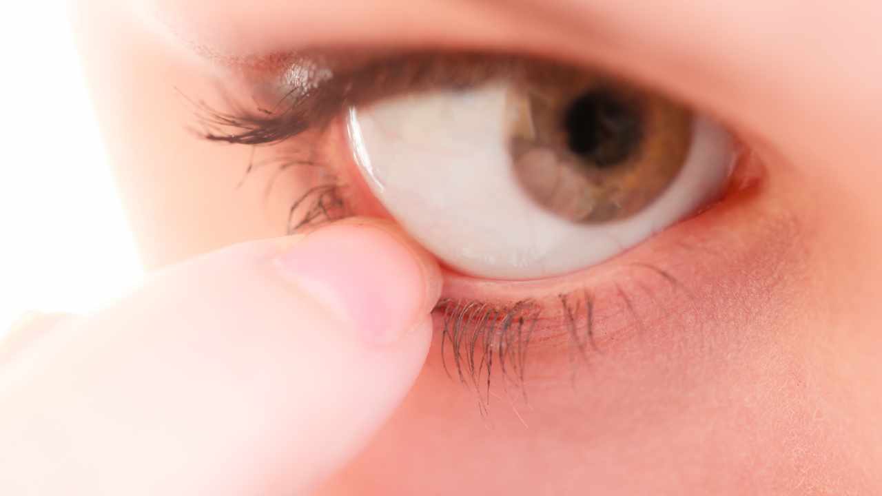 rimedi colpo di aria