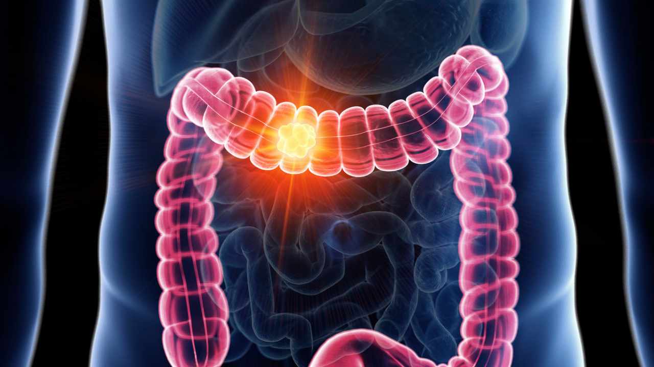 giovani e tumore colon-retto