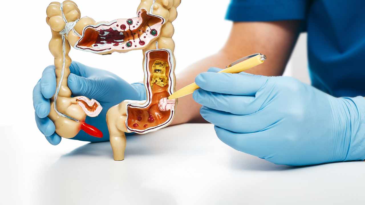 giovani e tumore colon-retto