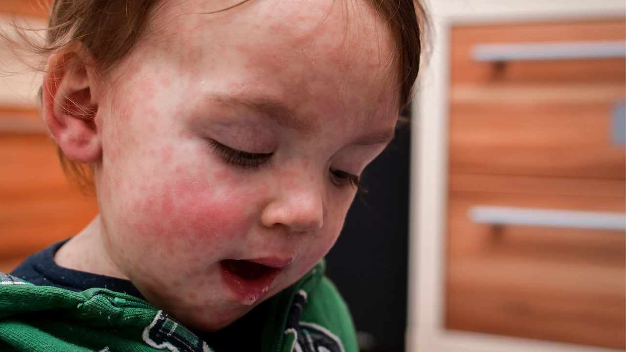 sintomi Sindrome di Kawasaki