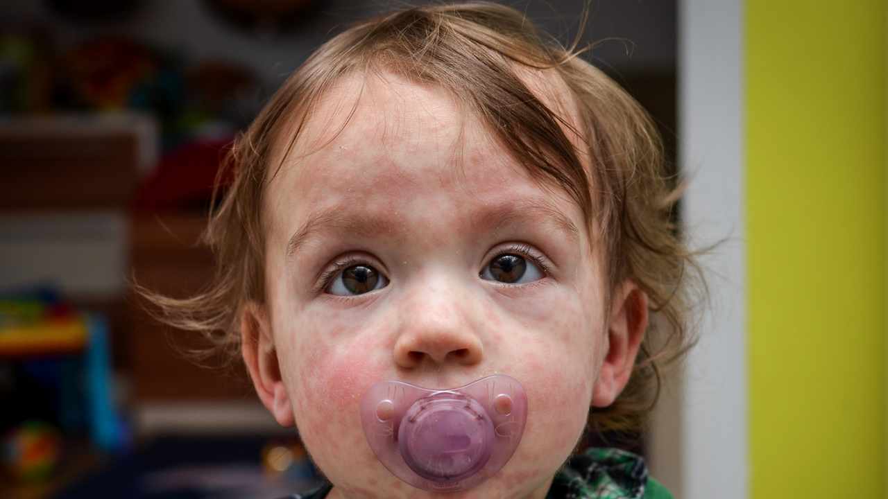 sintomi Sindrome di Kawasaki