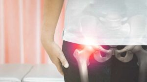 Quali sono le cause del dolore all’anca nelle donne?