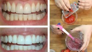 Come sbiancare i denti a casa usando solo 2 ingredienti facilmente disponibili…
