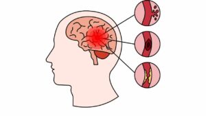 Segnali che avvertono di un ictus