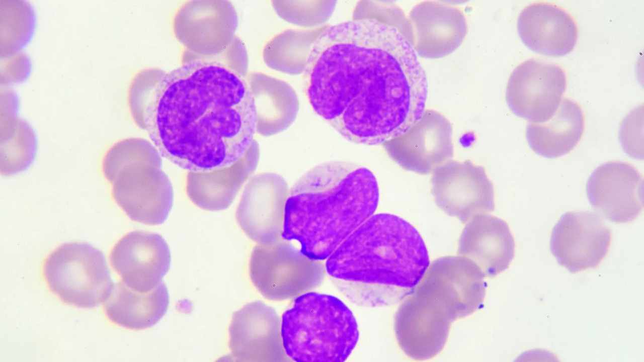 sintomi leucemia