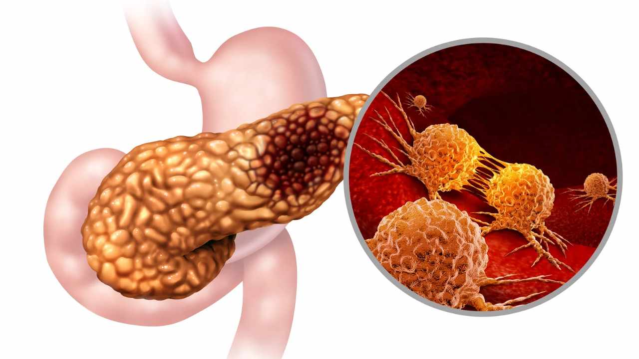 sintomi tumore al pancreas