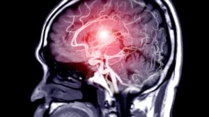 Aneurisma: sintomi che non devi assolutamente ignorare