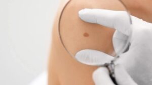 Segnali che devi assolutamente conoscere e che indicano la presenza di cancro della pelle