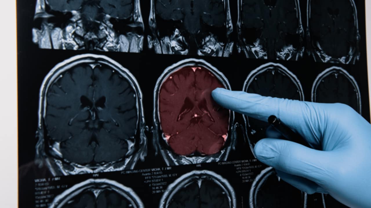 sintomi malattie cerebrovascolari