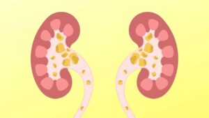 7 sintomi di insufficienza renale che tutti ignorano