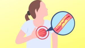 È possibile controllare i trigliceridi alti con la dieta?