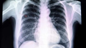 Perché si generano noduli polmonari e come rilevarli