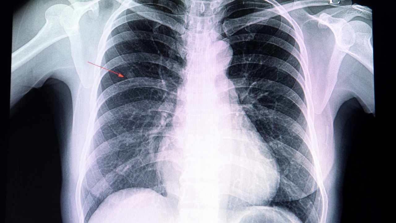 informazioni noduli polmonari