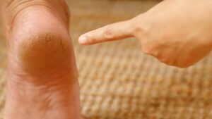 Talloni screpolati? Hai bisogno solo di questo e sarai pronta per i sandali!