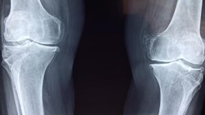 Tumore alle ossa: i sintomi che ti salvano la vita