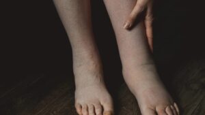 È un gonfiore che può avere diverse cause e che può indicare che qualcosa non va! Tutto quello che dovresti sapere sull’edema